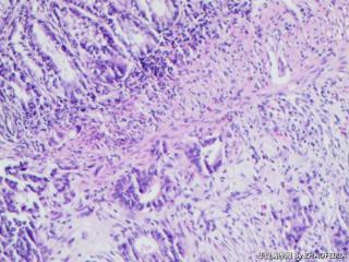 乙状结肠组织（肠镜活检）图6