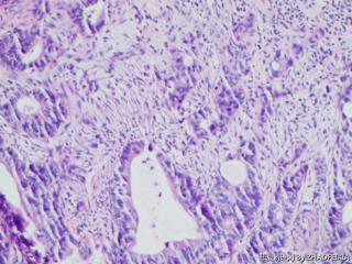 乙状结肠组织（肠镜活检）图14