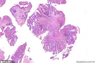 回盲部隆起物，高级别？腺癌？图5