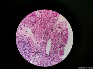 食管活检图13