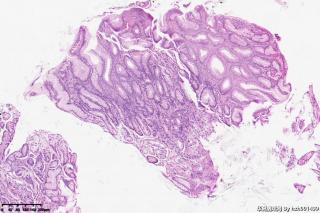 请教老师们这个胃窦粘膜有萎缩吗？图5