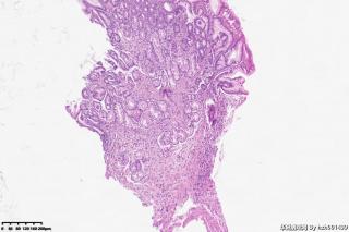 请教老师们这个胃窦粘膜有萎缩吗？图6