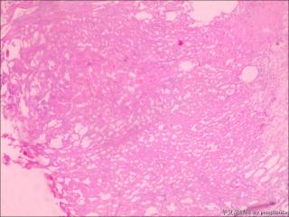 求教各位老师，这个怎么诊断？未见肿瘤组织图3