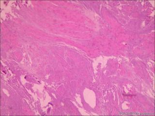 求教各位老师，这个怎么诊断？未见肿瘤组织图1