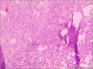 求教各位老师，这个怎么诊断？未见肿瘤组织图13