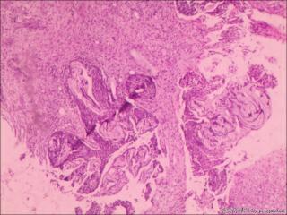 组织挤压，仅见少量上皮内瘤变组织?图2