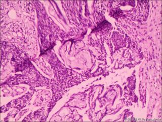 组织挤压，仅见少量上皮内瘤变组织?图5