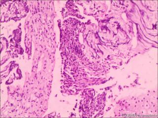 组织挤压，仅见少量上皮内瘤变组织?图4