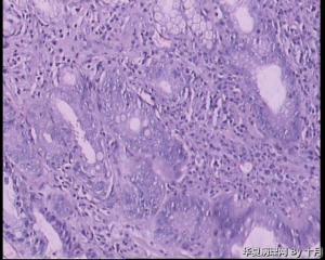 胃窦粘膜糜烂结节，部分腺体有低级别吗？图11