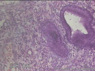 宫颈息肉图29