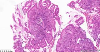 胃体息肉，粘膜下这些细胞有问题吗？图13