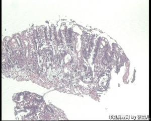 急！请老师看看，直肠粘膜活检，报低分化腺癌，还是粘液腺癌？图4