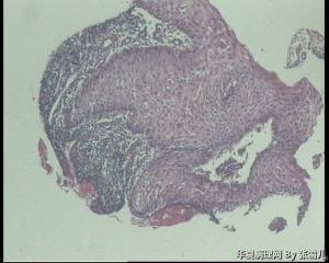 请老师看看食道粘膜活检图1