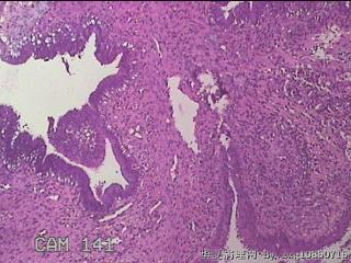 宫颈赘生物图18