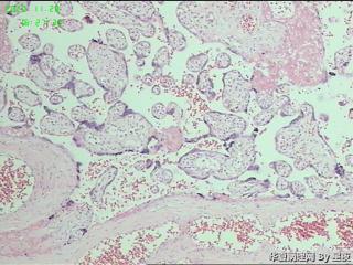 胎盘组织，请教？图1
