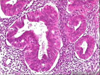 子宫内膜不典型增生伴局灶癌变？请教老师！图22
