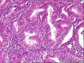 子宫内膜不典型增生伴局灶癌变？请教老师！图17