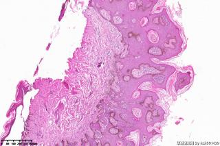 外阴赘生物，脂溢性角化症？图6