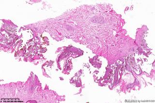 外阴赘生物，脂溢性角化症？图11