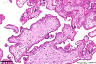 请老师们帮看看这些绒毛，需要排除葡萄胎吗？图16