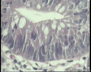 请教，结肠腺瘤，伴低级别上皮内瘤变吗？图10
