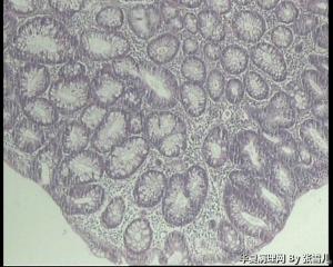 请教，结肠腺瘤，伴低级别上皮内瘤变吗？图2
