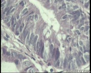 请教，结肠腺瘤，伴低级别上皮内瘤变吗？图12