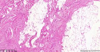 右肩部包块、纤维脂肪瘤？图10