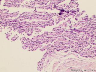 前列腺穿刺组织图10