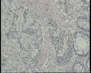 请老师看看，直肠息肉，就这些细胞，能直接报神经内分泌瘤吗？图4