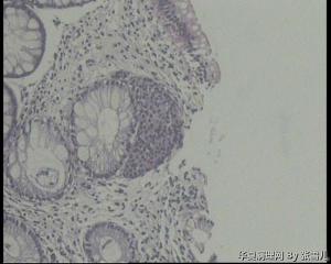 请老师看看，直肠息肉，就这些细胞，能直接报神经内分泌瘤吗？图7