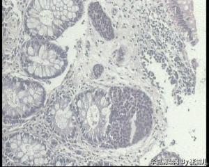 请老师看看，直肠息肉，就这些细胞，能直接报神经内分泌瘤吗？图6