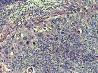 宫颈鳞癌？图6