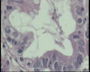 胃粘膜腺体有轻度非典型增生吗？图7