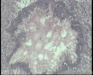 请老师看看卵巢粘液性囊腺瘤，局灶基底细胞增多，无异型，不能算交界吧？图13