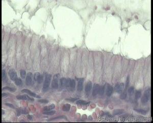 请老师看看卵巢粘液性囊腺瘤，局灶基底细胞增多，无异型，不能算交界吧？图4