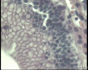 请老师看看卵巢粘液性囊腺瘤，局灶基底细胞增多，无异型，不能算交界吧？图10