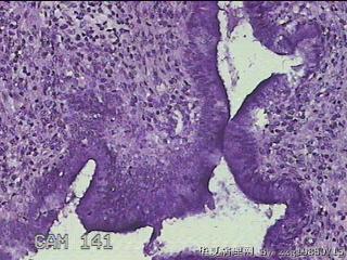宫颈赘生物图16