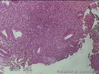 宫腔组织图17
