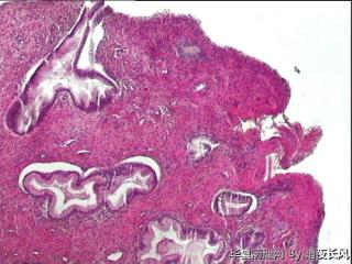 宫颈组织，上皮腺体鳞化，还是低级别？图2