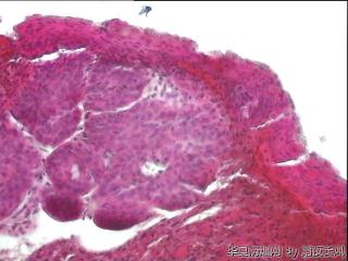 宫颈组织，上皮腺体鳞化，还是低级别？图7