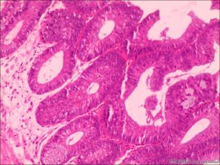 管状腺瘤伴低级别？图5