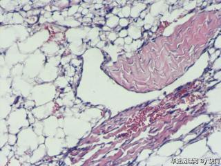 血管平滑肌脂肪瘤吗？图10