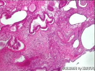 请教老师，宫颈管内膜及子宫内膜息肉（患者纵膈子宫）？图7