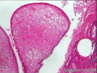 请教老师，宫颈管内膜及子宫内膜息肉（患者纵膈子宫）？图3