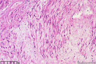 平滑肌瘤，变性？坏死？图13