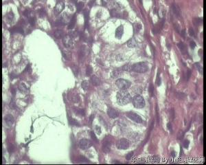 请老师会诊，46岁宫内膜，子宫内膜腺癌?图20