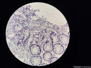 乙状结肠增生性息肉？图4