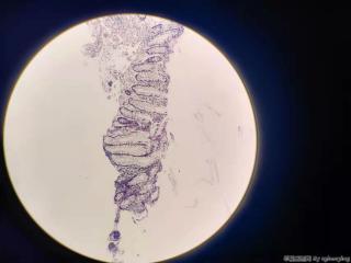 乙状结肠增生性息肉？图3
