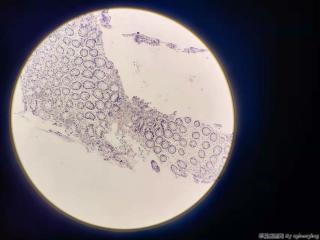 乙状结肠增生性息肉？图8